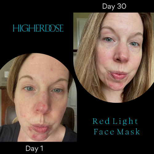 Led Face Masks: Do They Work for Acne And Aging And Pigmentation Led Face Masks: Do They Work for Acne And Aging And Pigmentation