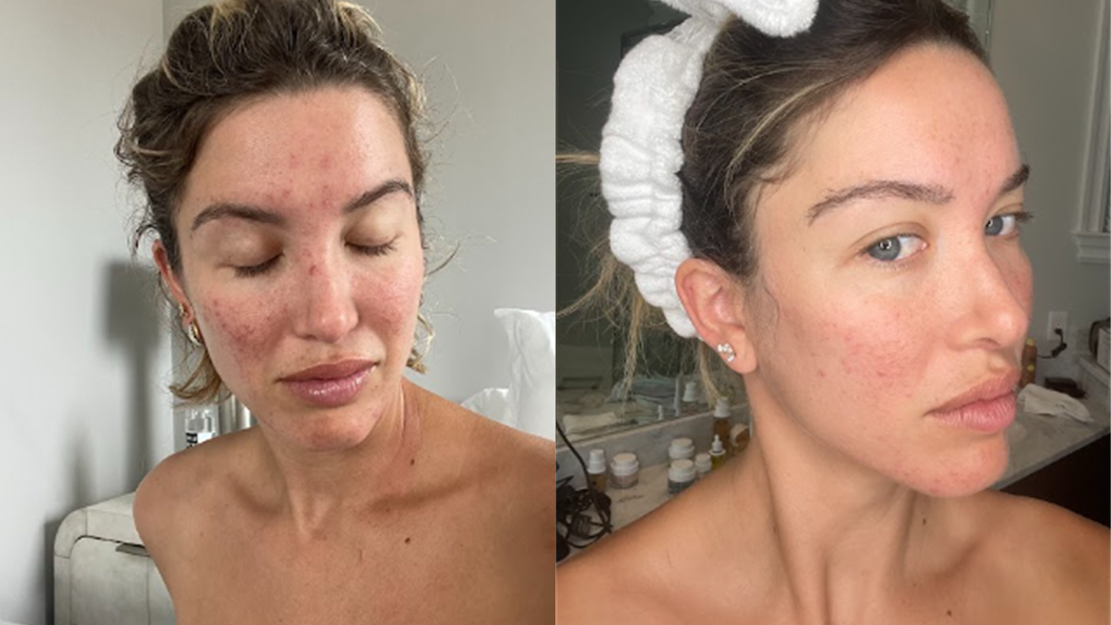 Before and after photos of Melissa Boloña who underwent red light therapy for acne scars