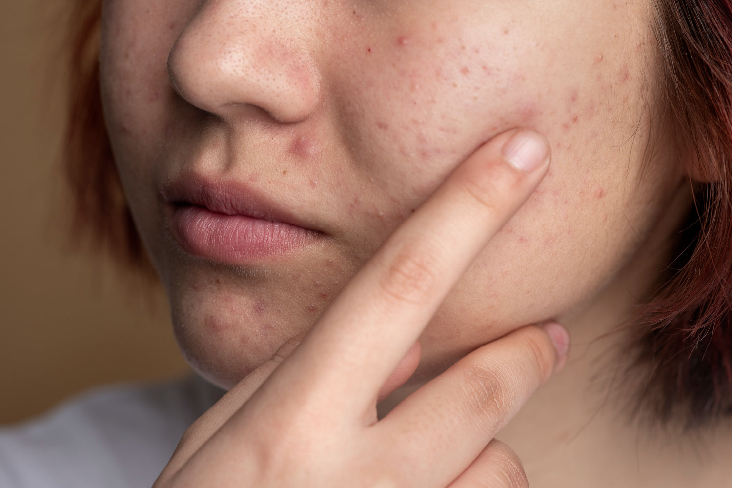 Skin with rosacea